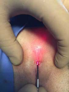 Νέα ενδοσκοπική θεραπεία με LASER – Τέλος στην Κύστη Κόκκυγος