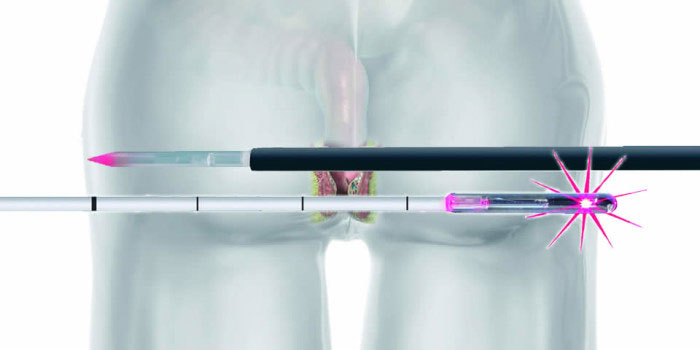 Νέα ενδοσκοπική θεραπεία με LASER – Τέλος στην Κύστη Κόκκυγος